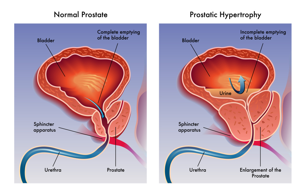 Prostatic hypertrophy 2.jpg Prostatic hypertrophy 2.jpg
