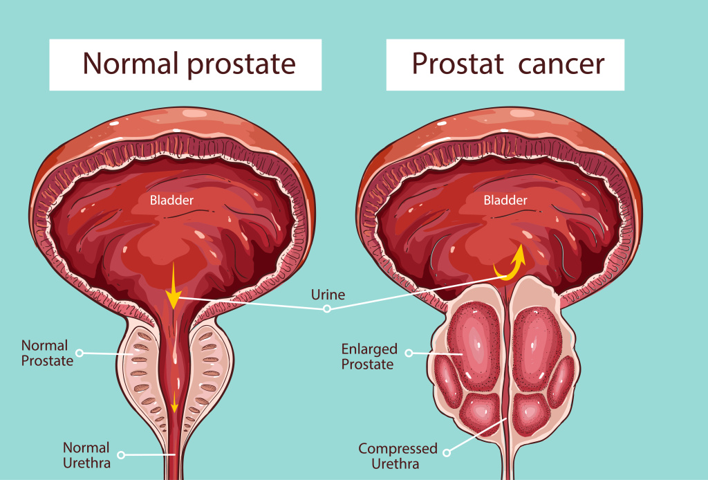 prostat.jpg